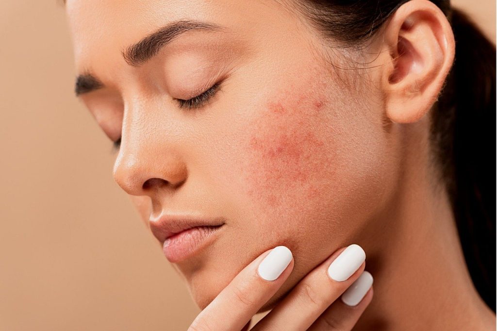 Real Results and Testimonials from Acne Therapeutic System Users