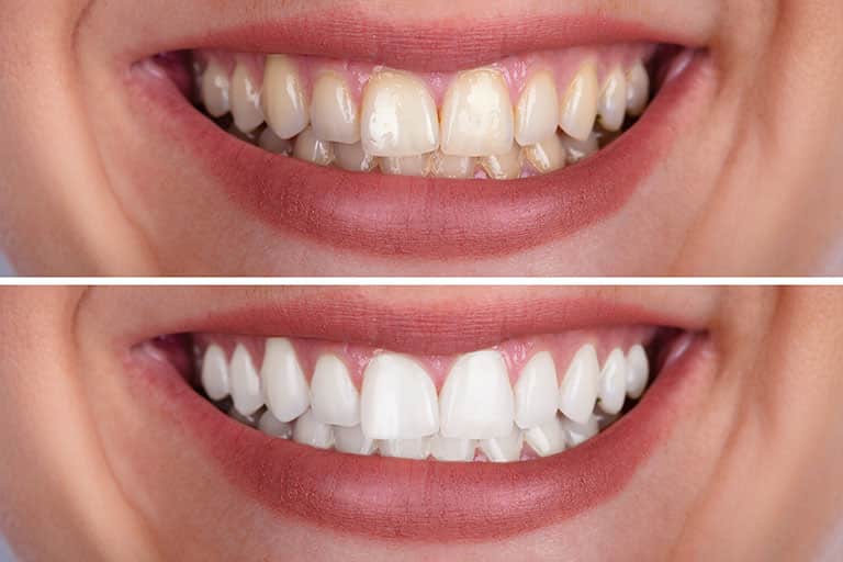 Composite Bonding's Role in Personalising Dental Care