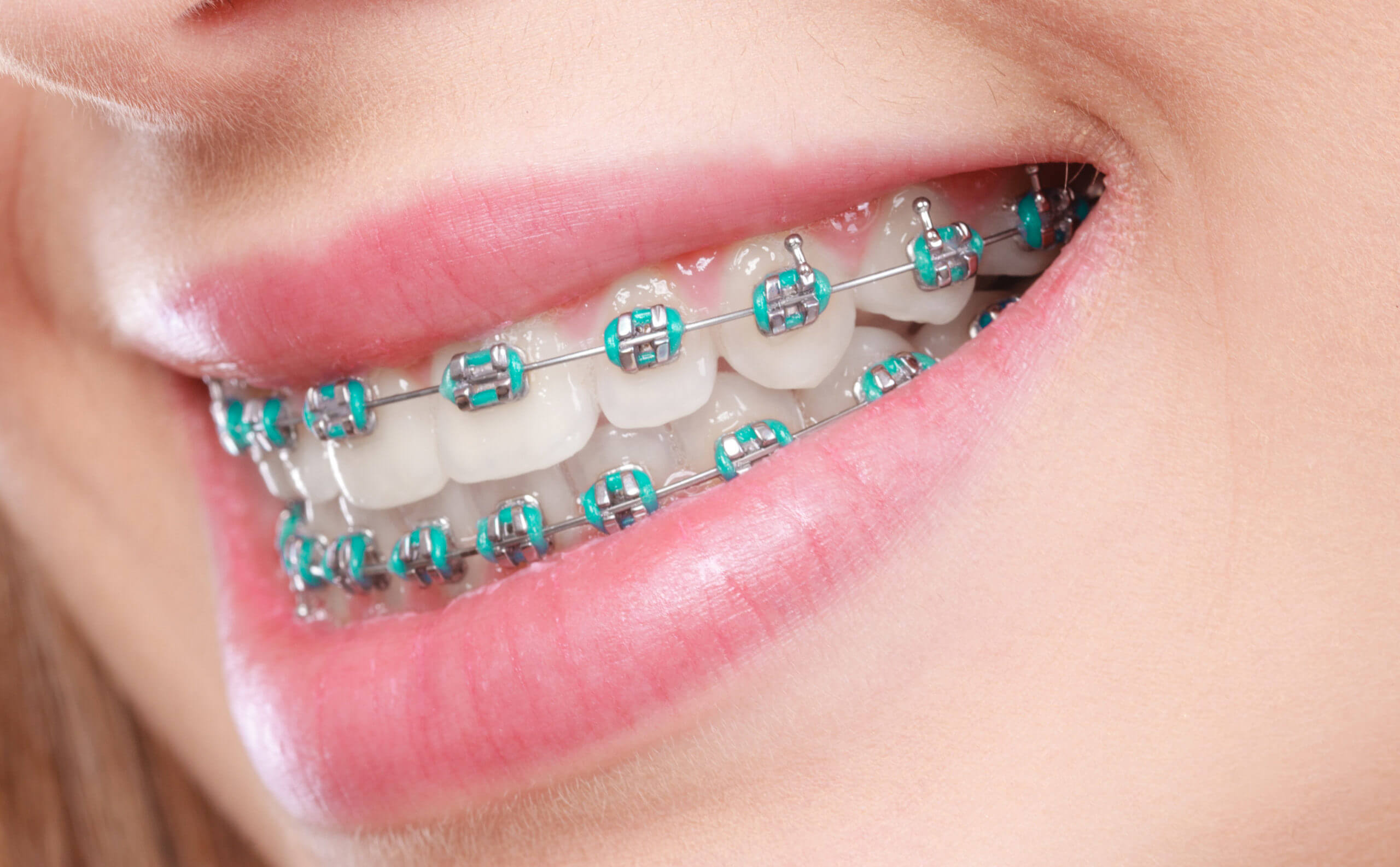 Embracing Orthodontic Artistry: Creating Unique Braces Experiences